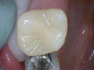 After Dental Fillings and Restoration