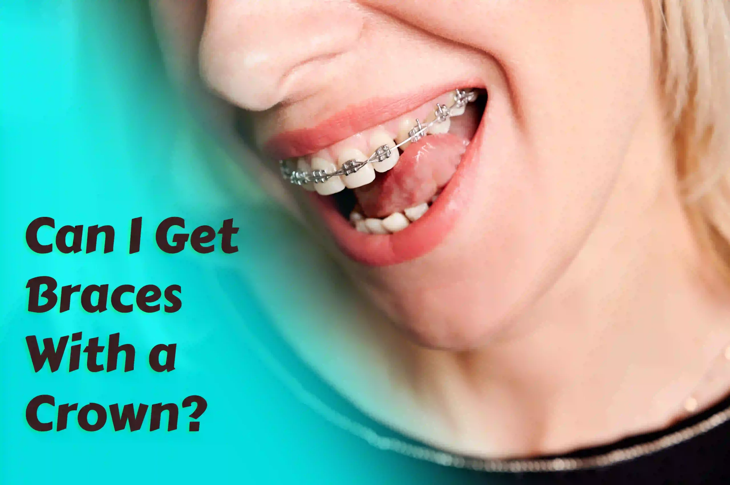 A certified orthodontist can assess your dental situation and provide a tailored treatment plan, considering crown availability and potential crown adjustments or removals.