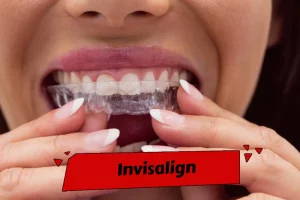 Invisalign is a popular teeth alignment method using removable, comfortable aligners that gradually shift teeth into position, but may take longer to achieve results compared to dental crowns.